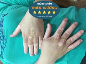 Hình ảnh: Bạch biến ở bàn tay