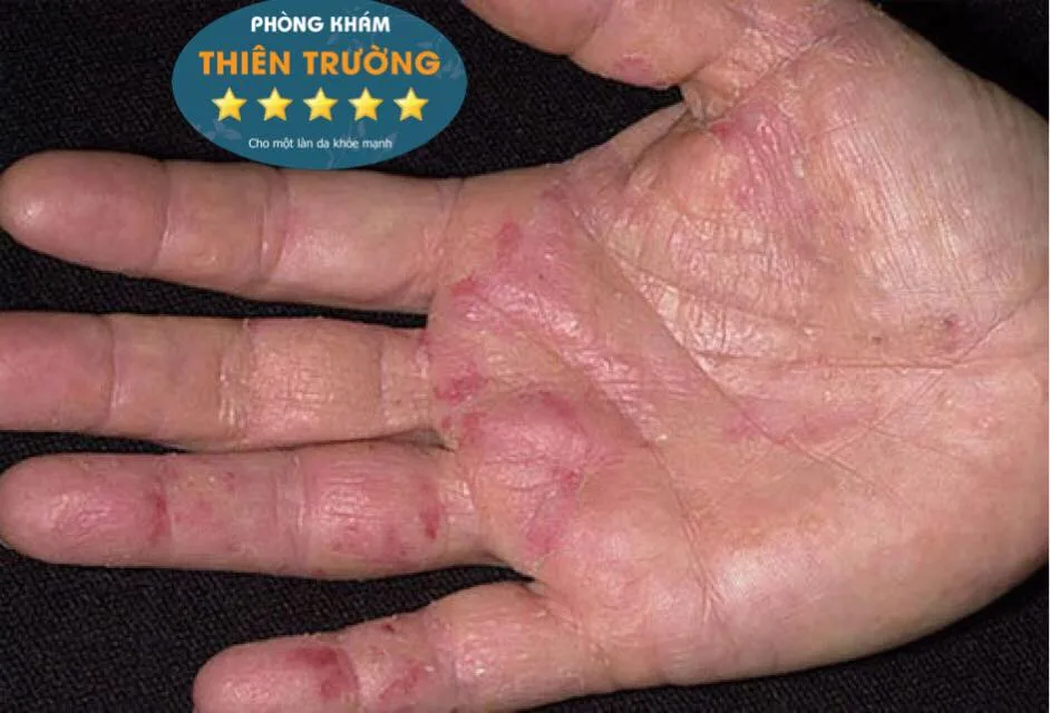 Hình ảnh: Tổ đỉa vùng tay bệnh nhân