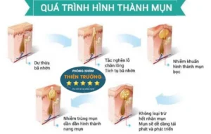 Hình ảnh: Quá trình hình thành nhân mụn