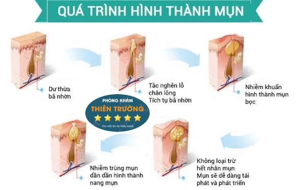 Hình ảnh: Quá trình hình thành nhân mụn
