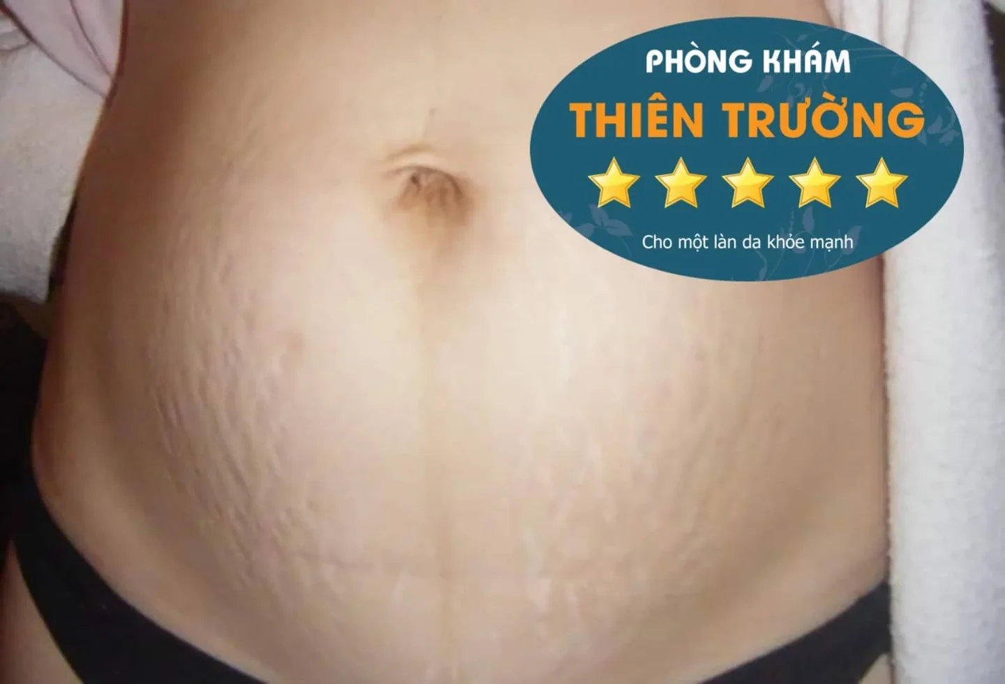 Hình ảnh: Rạn da