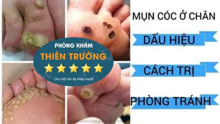 Hình ảnh: Mun cóc