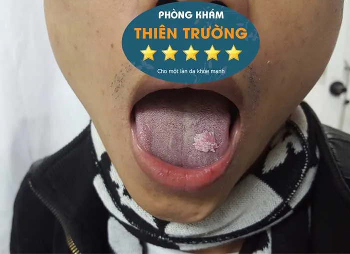 Hình ảnh: Bệnh sùi mào gà 