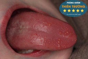 Giai-đoạn-ủ-bệnh-sùi-mào-gà