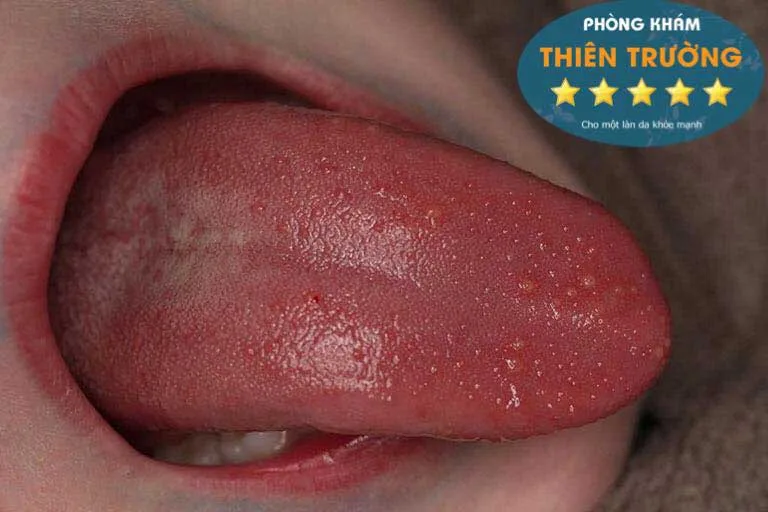 Giai-đoạn-ủ-bệnh-sùi-mào-gà