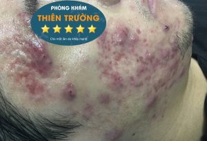 Hình ảnh: Mụn mủ