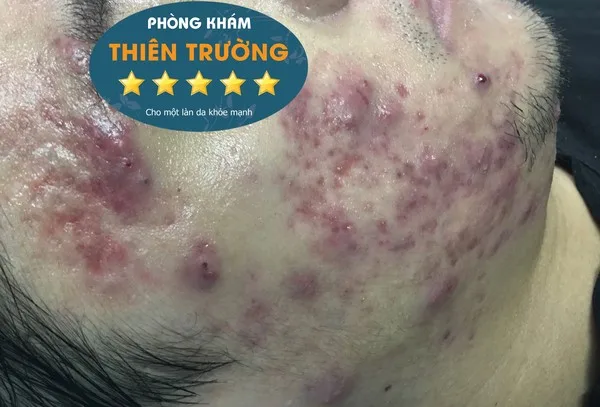 Hình ảnh: Mụn mủ