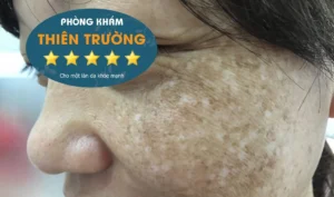 Hình ảnh: Nám da.