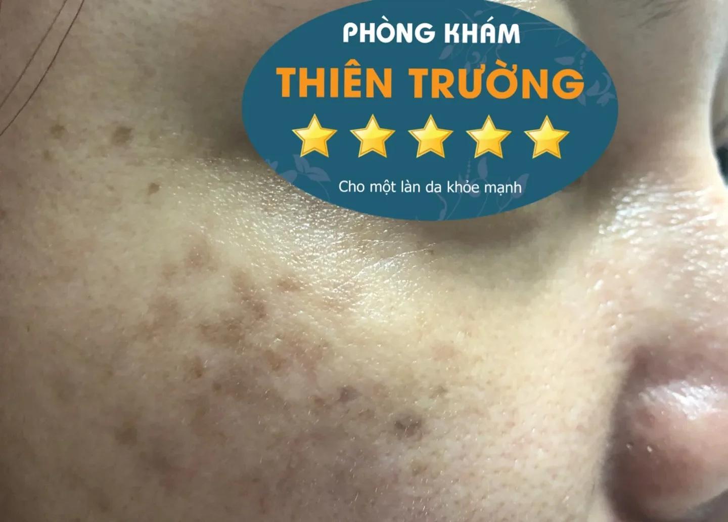 Hình ảnh: Da tàn nhang
