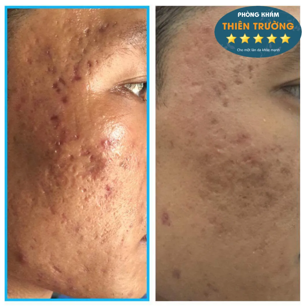 Hình ảnh: Khách hàng bị sẹo lõm.