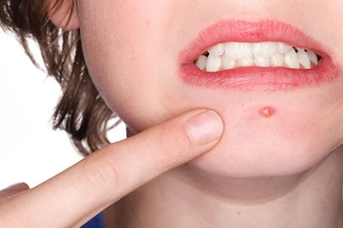 Hình ảnh: Bệnh lý do vi khuẩn