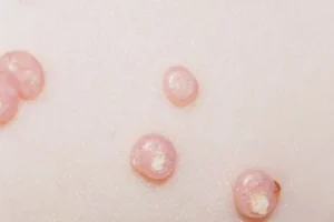 Hình ảnh: Bệnh da do vi rirrus