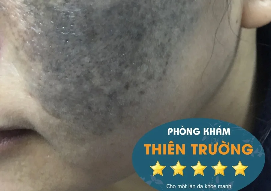 Hình ảnh: Bớt sắc tố bên mà trái.