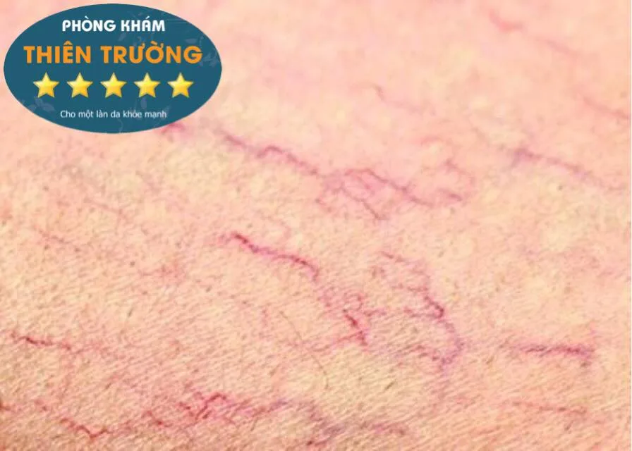 Hình ảnh: Giãn mao mạch phóng to