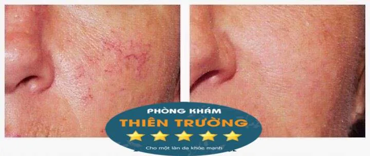 Hình ảnh: Trước và sau khi điều trị giãn mao mạch
