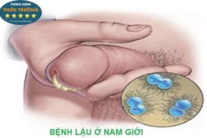 bệnh lậu