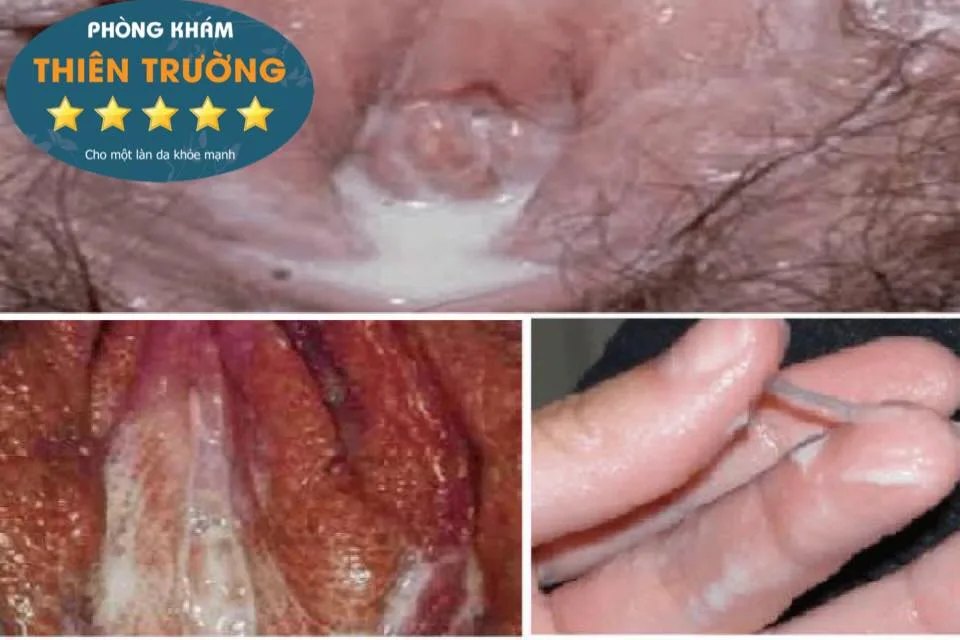 Hình ảnh: Bệnh lậu ở nữ giới