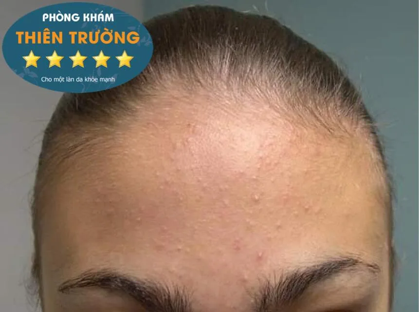 Hình ảnh: Mụn ẩn vùng trán 
