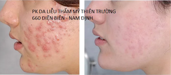 Hình ảnh: Trước và sau khi điều trị mụn