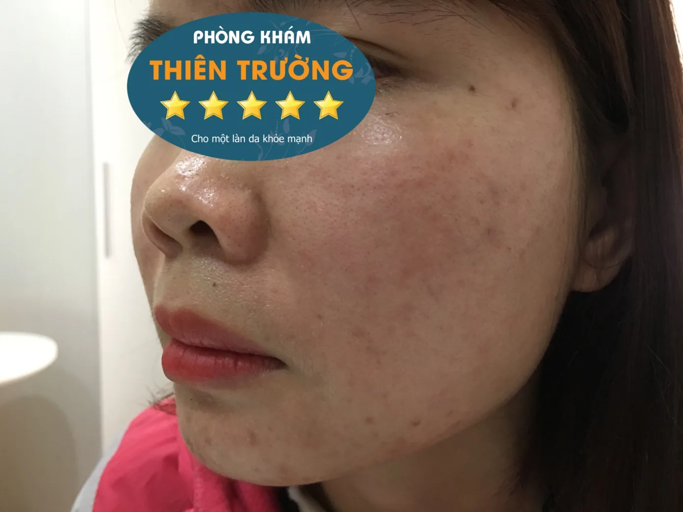 Hình ảnh: Da giảm dầu nhờn sau hỗ trợ điều trị