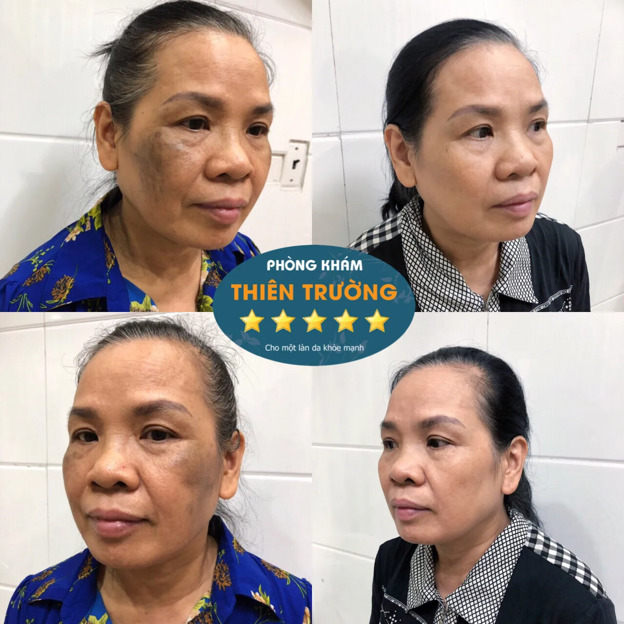 Hình ảnh: Khách hàng đã hỗ trợ điều trị nám tại Phòng khám Da liễu Thẩm mỹ Thiên Trường