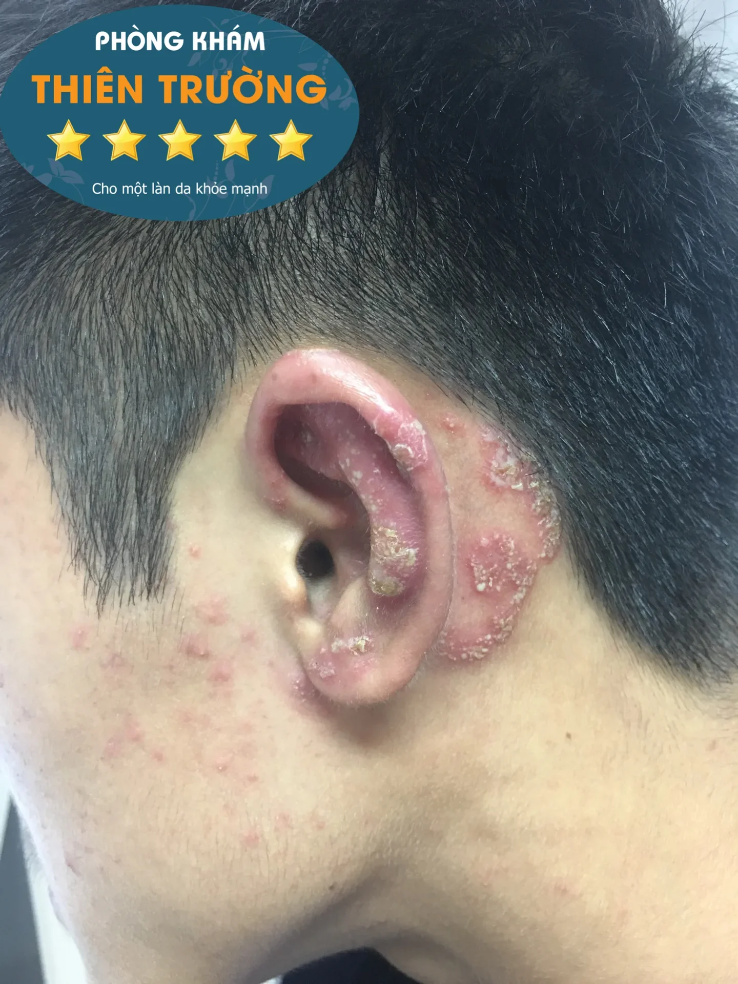 Hình ảnh: Bệnh nấm da vùng đầu