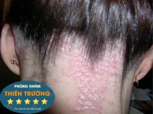 Hình ảnh: Nấm da đầu