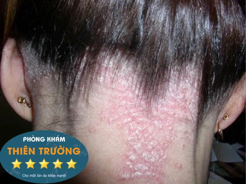 Hình ảnh : Nấm da đầu.