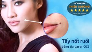 Hình ảnh: Nốt ruồi