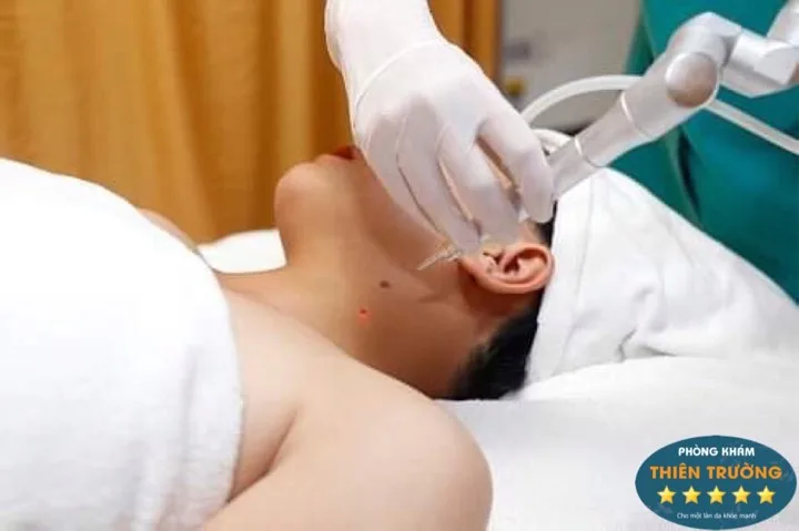 nốt ruồi 2
