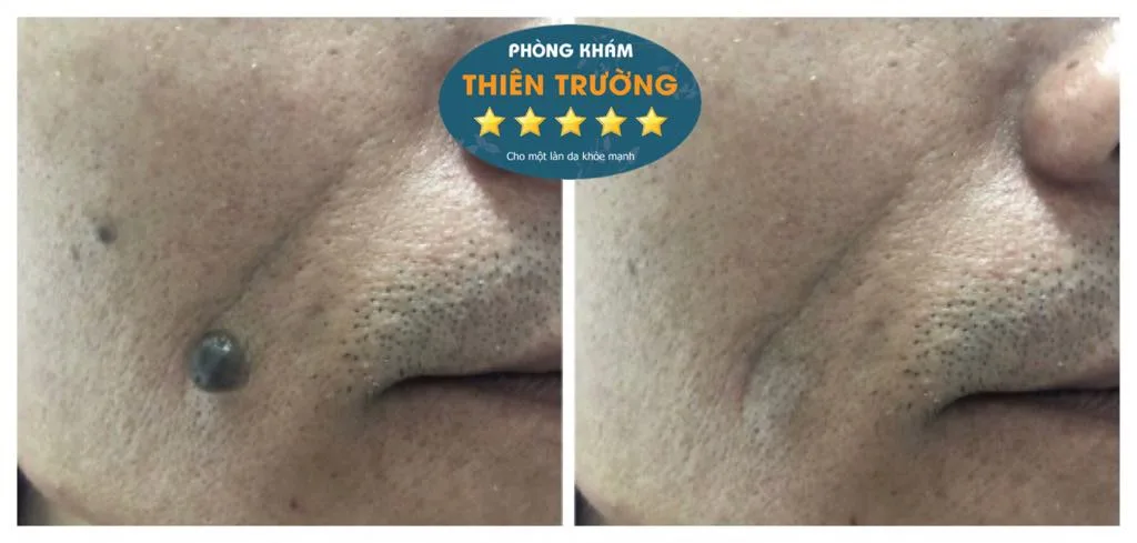 Hình ảnh: Ảnh trước và sau khi hỗ trợ điều trị nốt ruồi