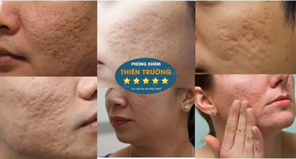 Hình ảnh: Sẹo lõm ở 2 bên má.