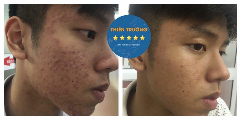 Hình ảnh: Thâm mụn mờ dần sau hỗ trợ điều trị