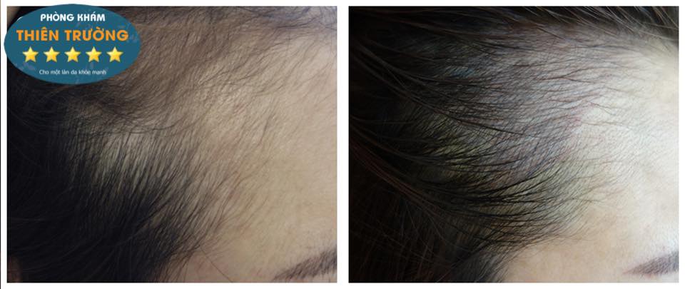 Hình ảnh: Ảnh trước sau khi thực hiện điêu khắc chân tóc 4D