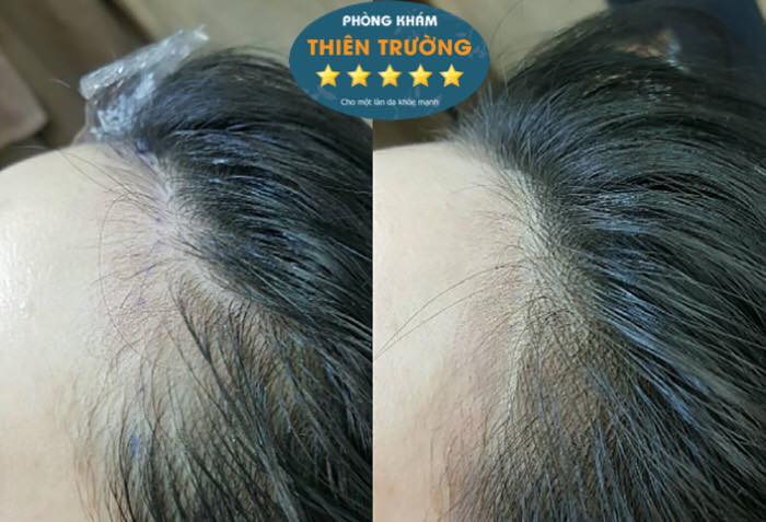 Hình ảnh: Điêu khắc chân tóc 4D tại Phun thêu Thẩm mỹ Thiên Trường