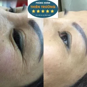 Hình ảnh: Xóa bỏ nếp nhăn vùng mắt 