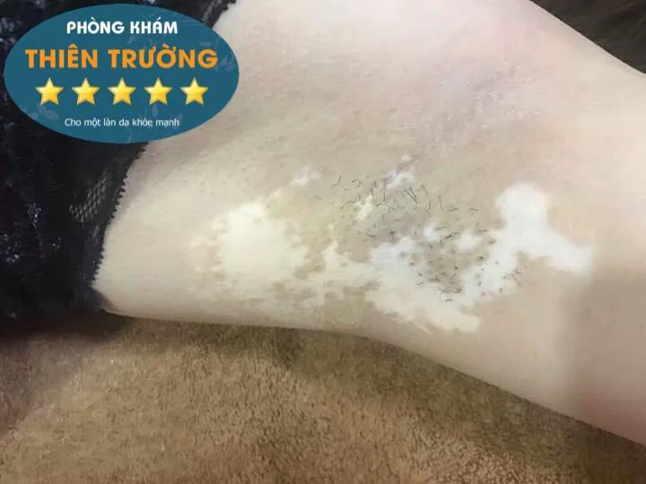 Hình ảnh: Bệnh bạch biến