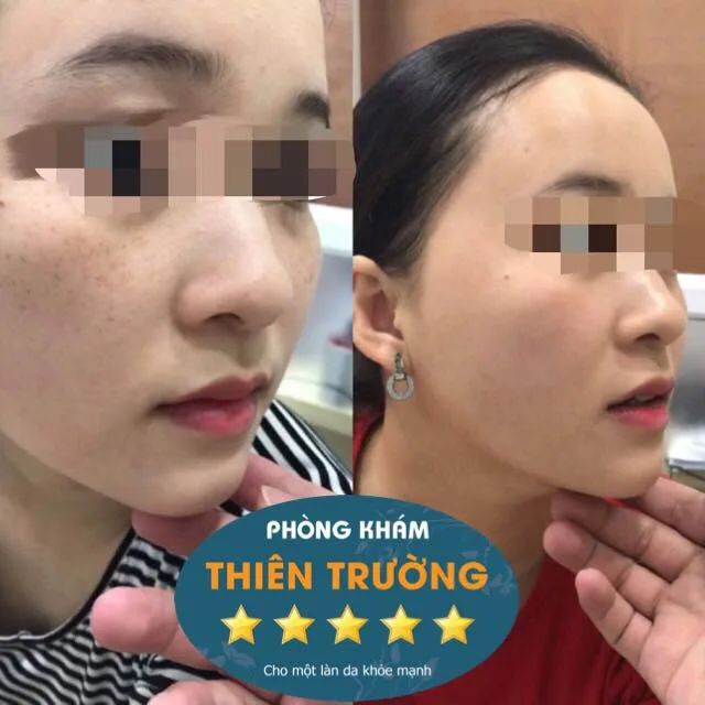 Hình ảnh: Trước và sau khi hỗ trợ điều trị nám