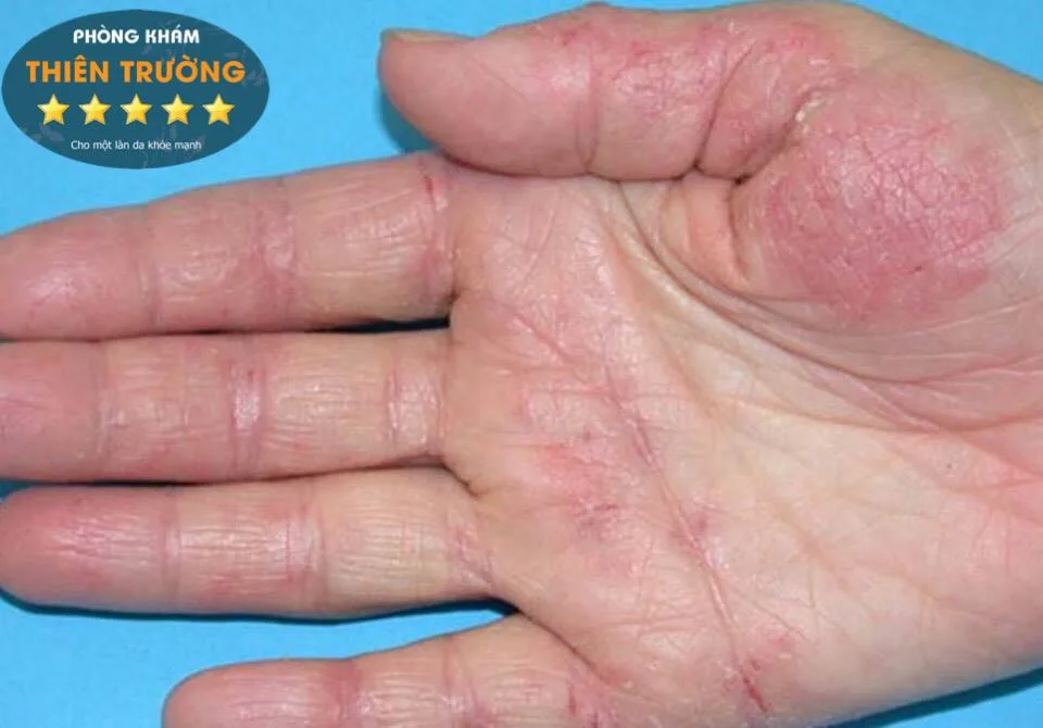 Hình ảnh: Bệnh nấm da tay
