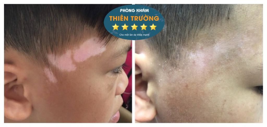 Hình ảnh: Trước và sau điều trị