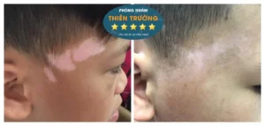 Hình ảnh: Trước và sau điều trị