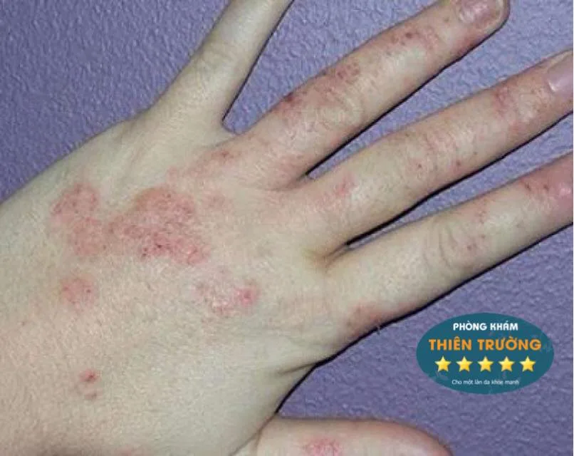 Hình ảnh: Nấm da
