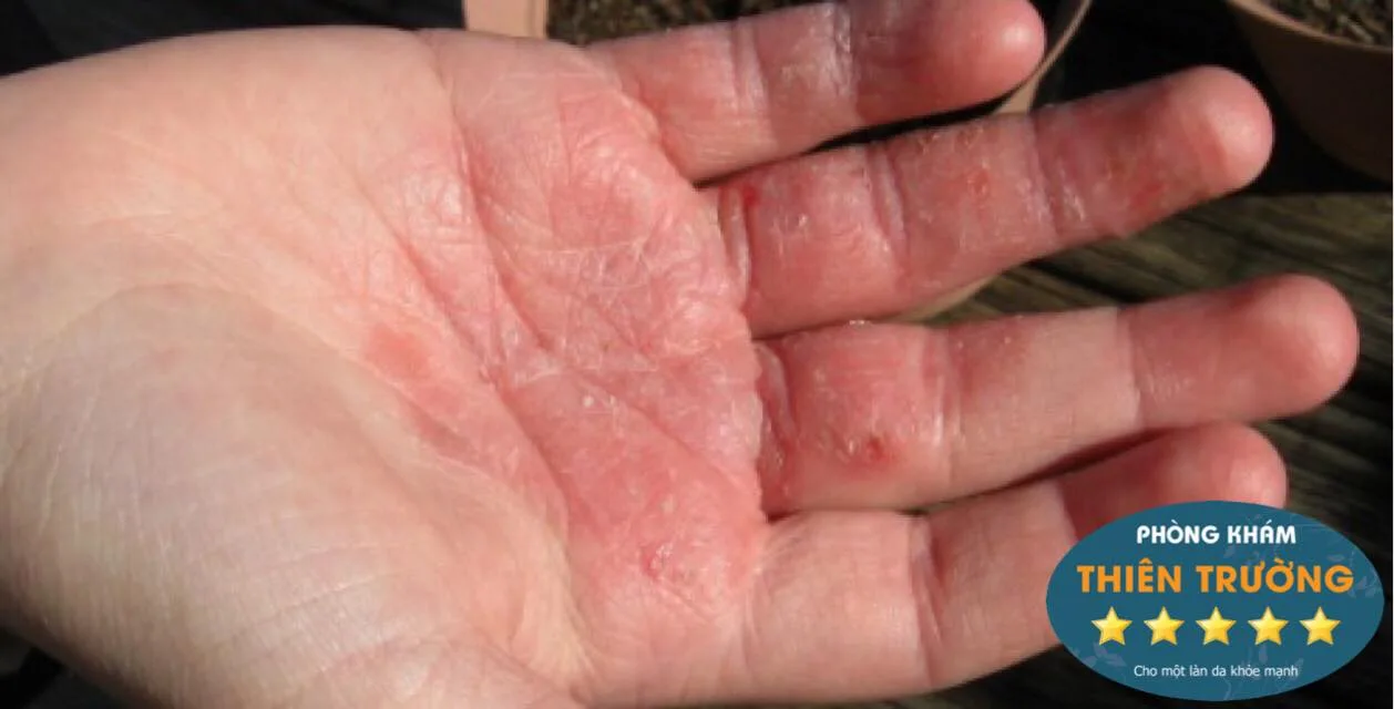 Hình ảnh: Nấm da tay