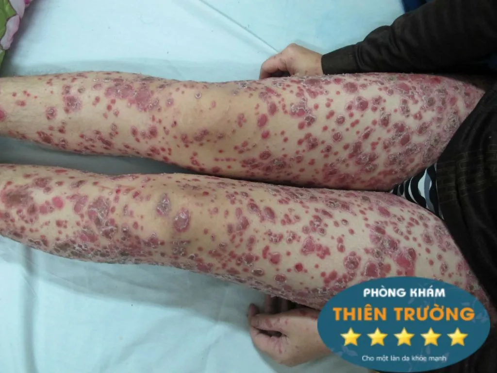 Hình ảnh: Vảy nến ở chân
