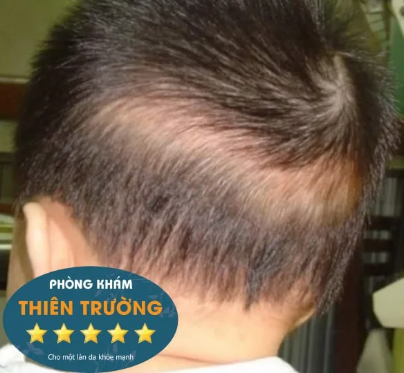 Hình ảnh: Rụng tóc vành khăn