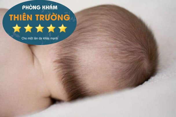 Trẻ bị rụng tóc vành khăn - Bệnh rụng tóc Da liễu Thiên Trường