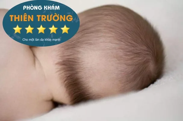 Hình ảnh: Rụng tóc vành khăn 