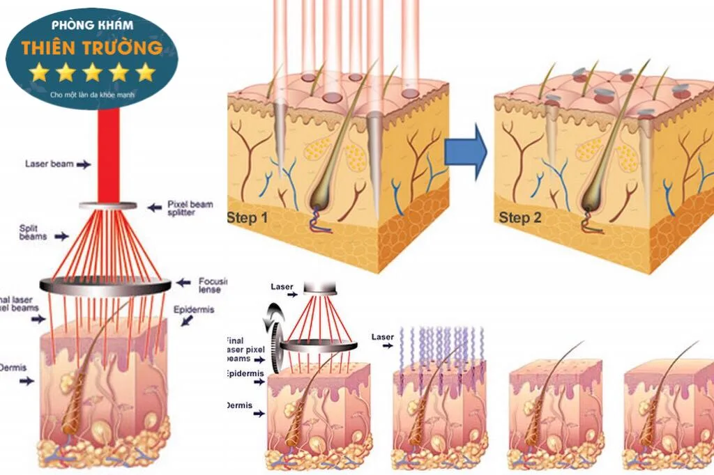 Hình ảnh: Nguyên nhân gây u tuyến mồ hôi là do rối loạn hệ thống collagenc