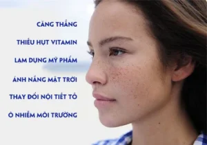 Hình ảnh : Nguyên nhân gây tàn nhang