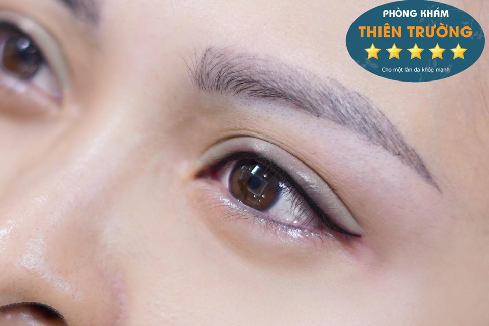 Hình ảnh: Phun mí mở tròng
